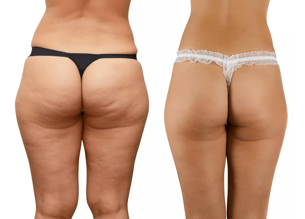 2 Step System to Remove Cellul - Food Near Snacks review and price